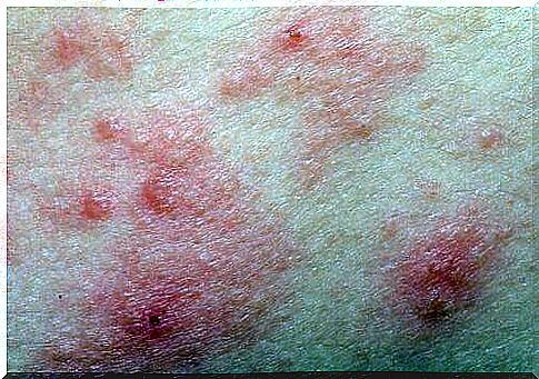 erythema