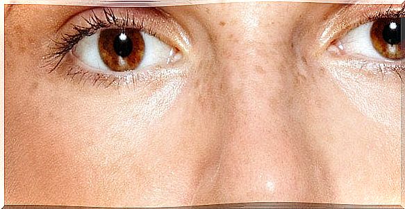 origin of melasma spots