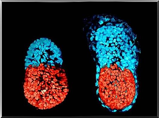 Parasitic embryo and fetus in fetus