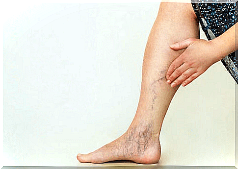 Varicose veins denote poor circulation of the legs