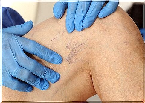 Treatment to reduce varicose veins