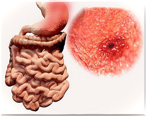 causes of flatulence: ulcers and parasites