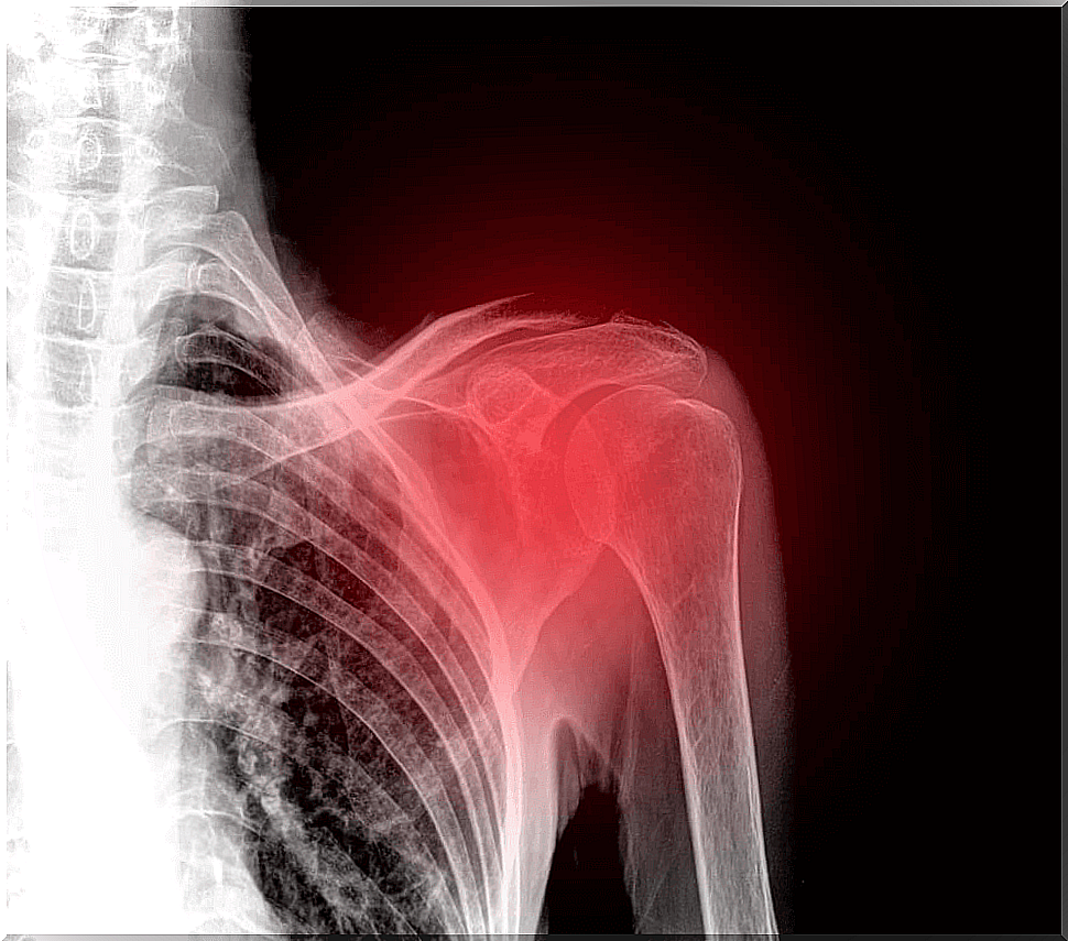 X-ray of the shoulder locating the ruptured rotator cuff