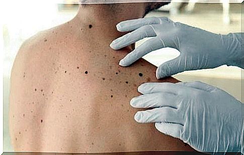 ABCDE skin cancer test