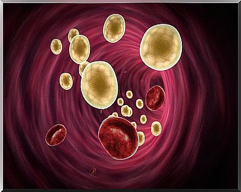 Xanthelasmas and cholesterol